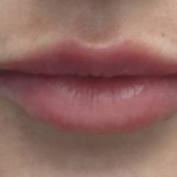 Fillers & Injectables Before & After Patient #21813