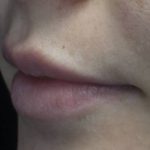 Lip Augmentation - Fillers Before & After Patient #21813