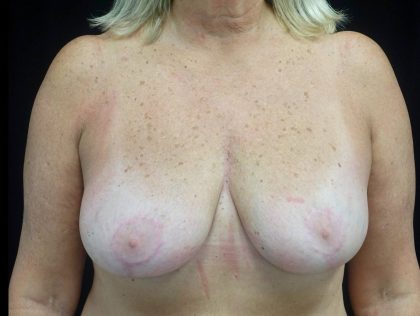Breast Implant Removal (Explant Surgery) Before & After Patient #21796