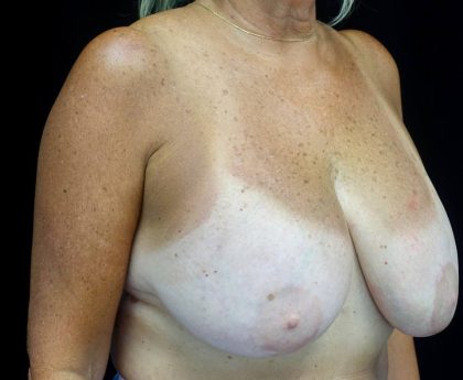 Breast Lift Before & After Patient #21796