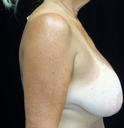 Breast Lift Before & After Patient #21796