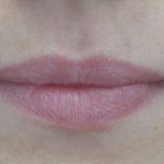 Lip Augmentation - Fillers Before & After Patient #21803