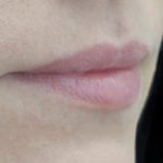 Lip Augmentation - Fillers Before & After Patient #21803