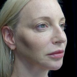 Fillers & Injectables Before & After Patient #21952