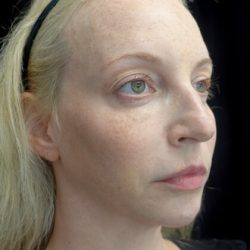 Fillers & Injectables Before & After Patient #21952