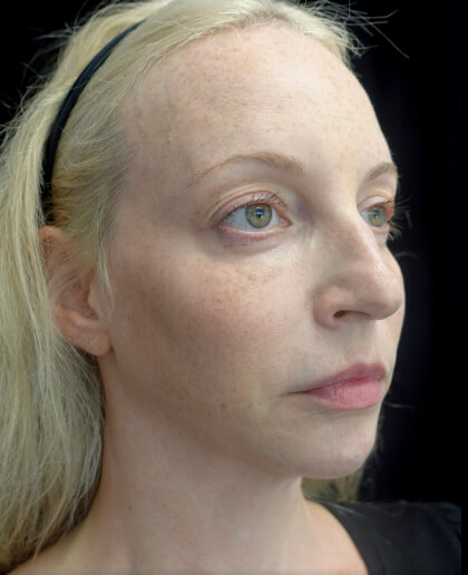 Fillers & Injectables Before & After Patient #21952