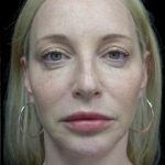 Lip Augmentation - Fillers Before & After Patient #21952