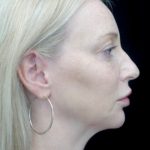 Fillers & Injectables Before & After Patient #21952
