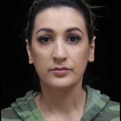 Otoplasty Before & After Patient #22312