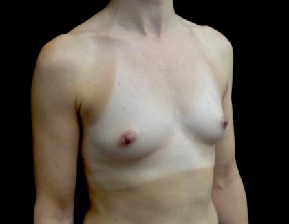 Breast Augmentation (Implants) Before & After Patient #22394