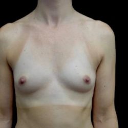 Breast Augmentation (Implants) Before & After Patient #22394