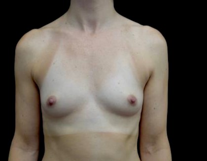 Breast Augmentation (Implants) Before & After Patient #22394