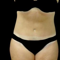 Lipoabdominoplasty Before & After Patient #22375