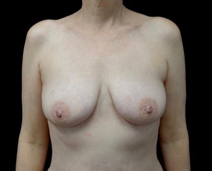 Breast Augmentation (Fat Transfer) Before & After Patient #22287