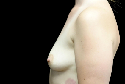 Breast Augmentation (Implants) Before & After Patient #22229