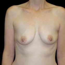 Breast Augmentation (Fat Transfer) Before & After Patient #22287