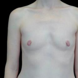 Breast Augmentation (Implants) Before & After Patient #22217