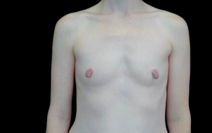 Breast Augmentation (Implants) Before & After Patient #22217