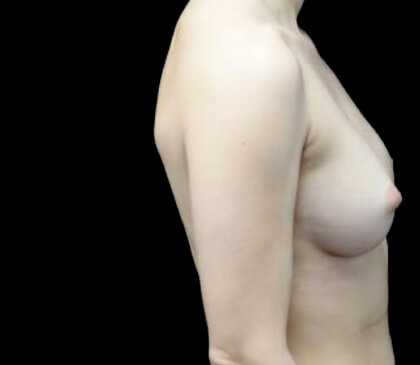 Breast Augmentation (Implants) Before & After Patient #22140