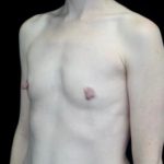 Breast Augmentation (Implants) Before & After Patient #22217