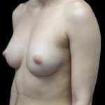 Breast Augmentation (Implants) Before & After Patient #22140