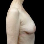 Breast Augmentation (Fat Transfer) Before & After Patient #22287