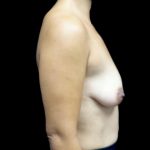 Breast Lift with Implants Before & After Patient #22059