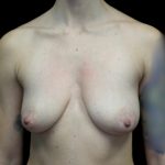 Breast Lift with Implants Before & After Patient #22027