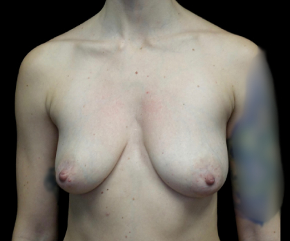 Breast Lift with Implants Before & After Patient #22027