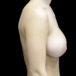 Breast Reduction Before & After Patient #22073