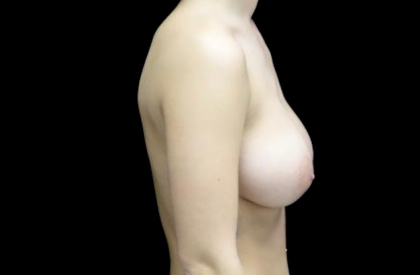 Breast Reduction Before & After Patient #22073