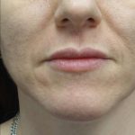 Lip Augmentation - Fillers Before & After Patient #22035