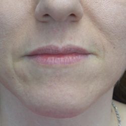 Lip Augmentation - Fillers Before & After Patient #22035