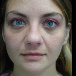 Fat Transfer to Face Before & After Patient #22224