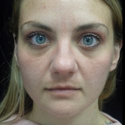 Fat Transfer to Face Before & After Patient #22224