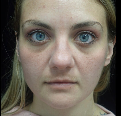 Fat Transfer to Face Before & After Patient #22224