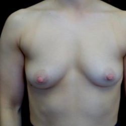 Breast Augmentation (Implants) Before & After Patient #22326