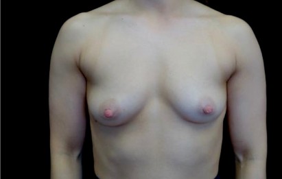 Breast Augmentation (Implants) Before & After Patient #22326