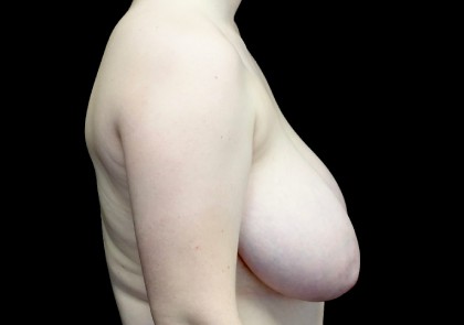 Breast Reduction Before & After Patient #22319