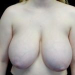Breast Reduction Before & After Patient #22319