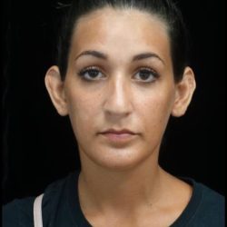 Otoplasty Before & After Patient #22312