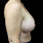 Breast Reduction Before & After Patient #22157