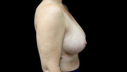 Breast Reduction Before & After Patient #22157