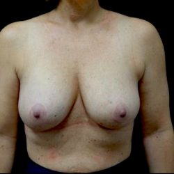 Breast Reduction Before & After Patient #22157