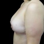 Breast Reduction Before & After Patient #22402
