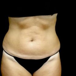 Lipoabdominoplasty Before & After Patient #22375