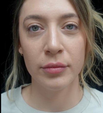 Juvederm Before & After Patient #22359