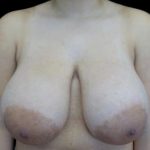 Breast Reduction Before & After Patient #22334