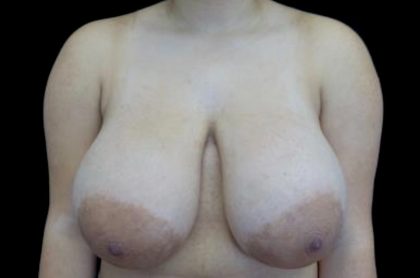 Breast Reduction Before & After Patient #22334
