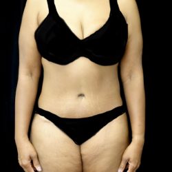 Lower Body Lift Before & After Patient #22018